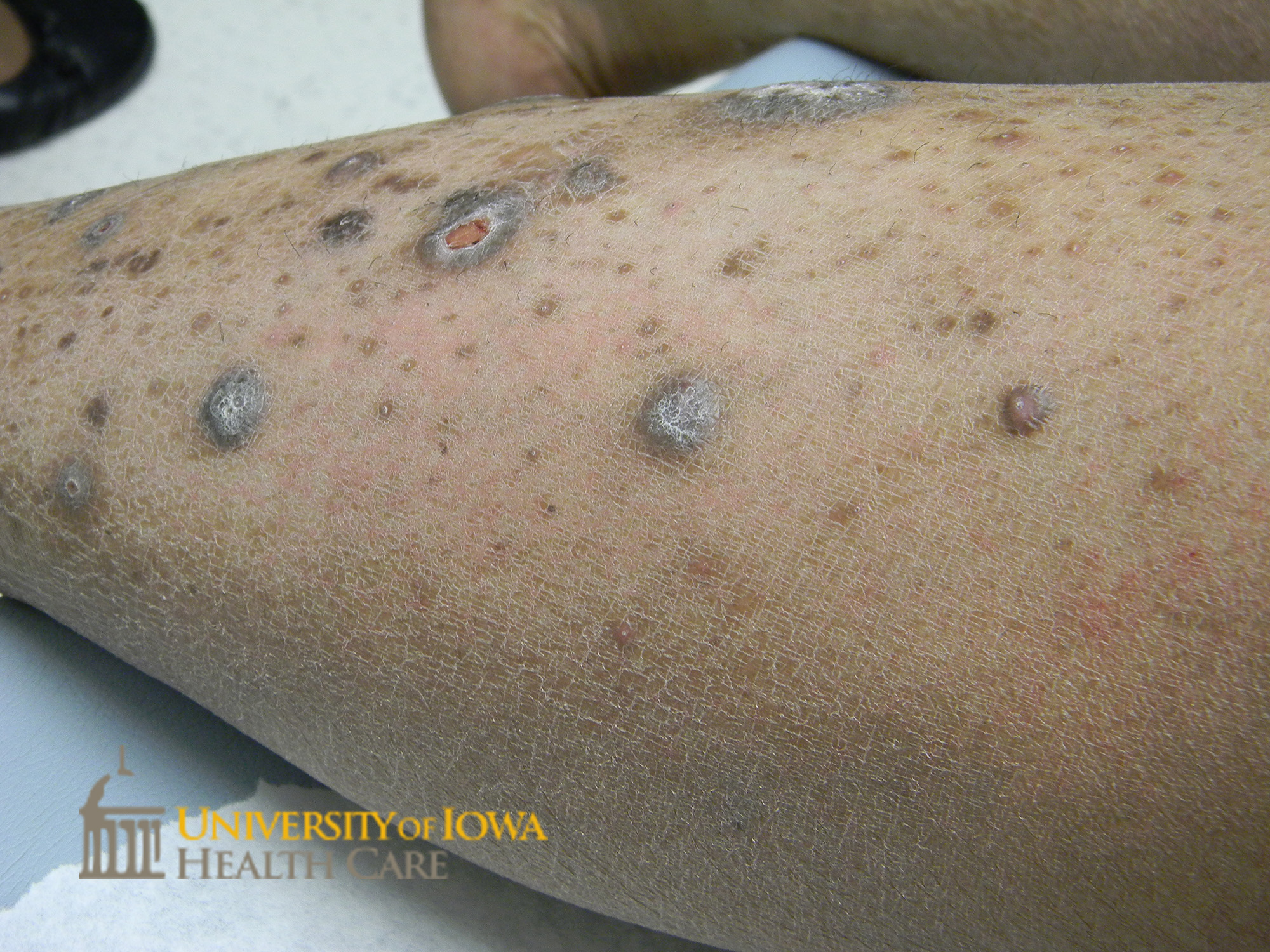 Thick hyperpigmented to violaceous polygonal papules and plaques, some